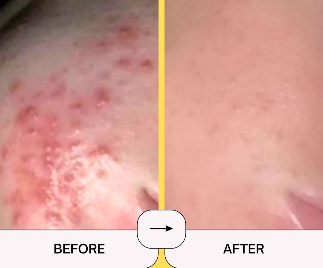 Acne Buster Bundle